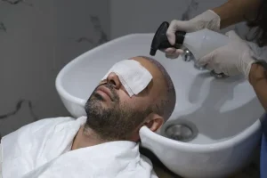 بهترین شامپو بعد از کاشت مو